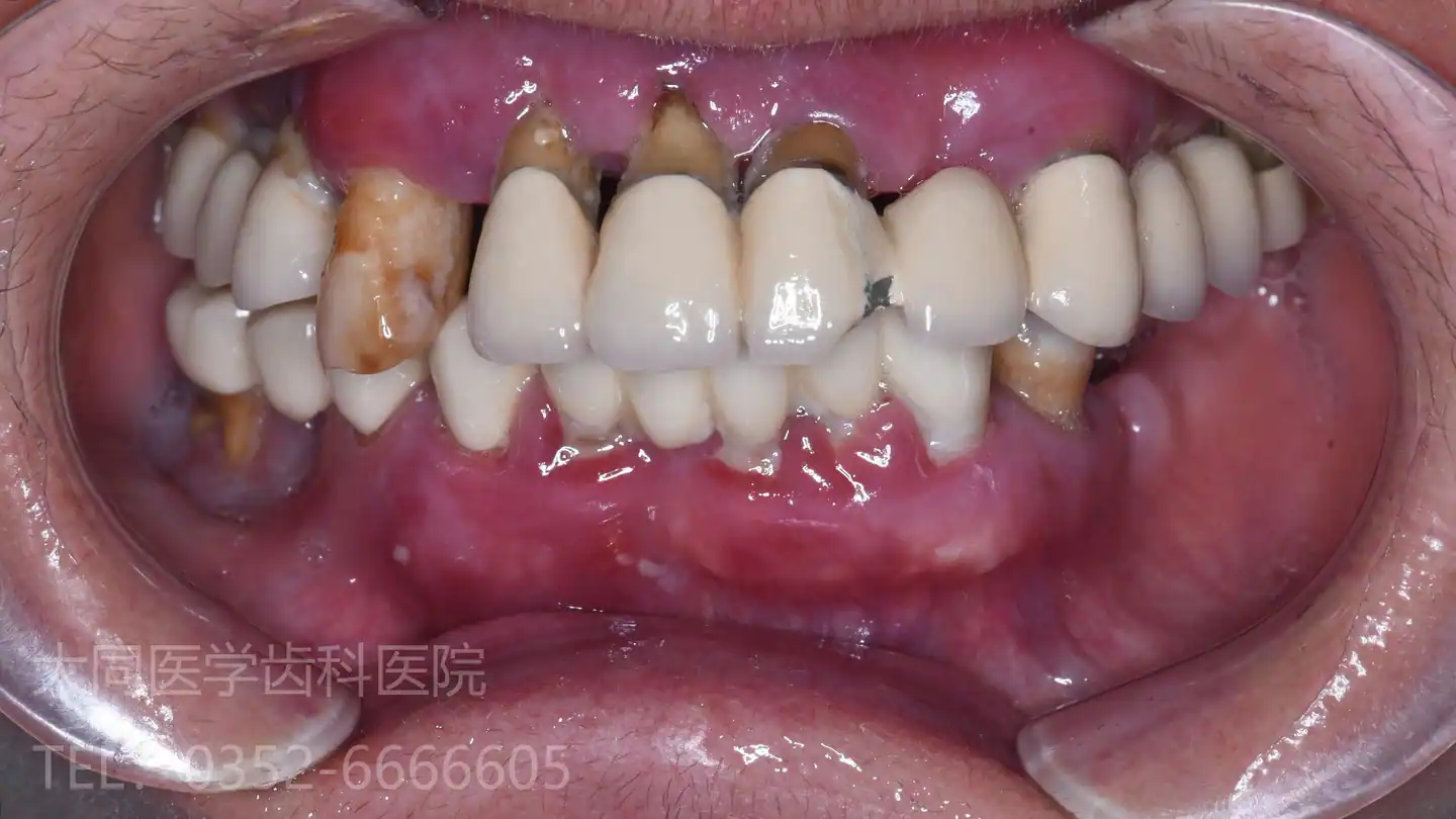 种植修复:全口咀嚼功能重建方向口内局部影像
