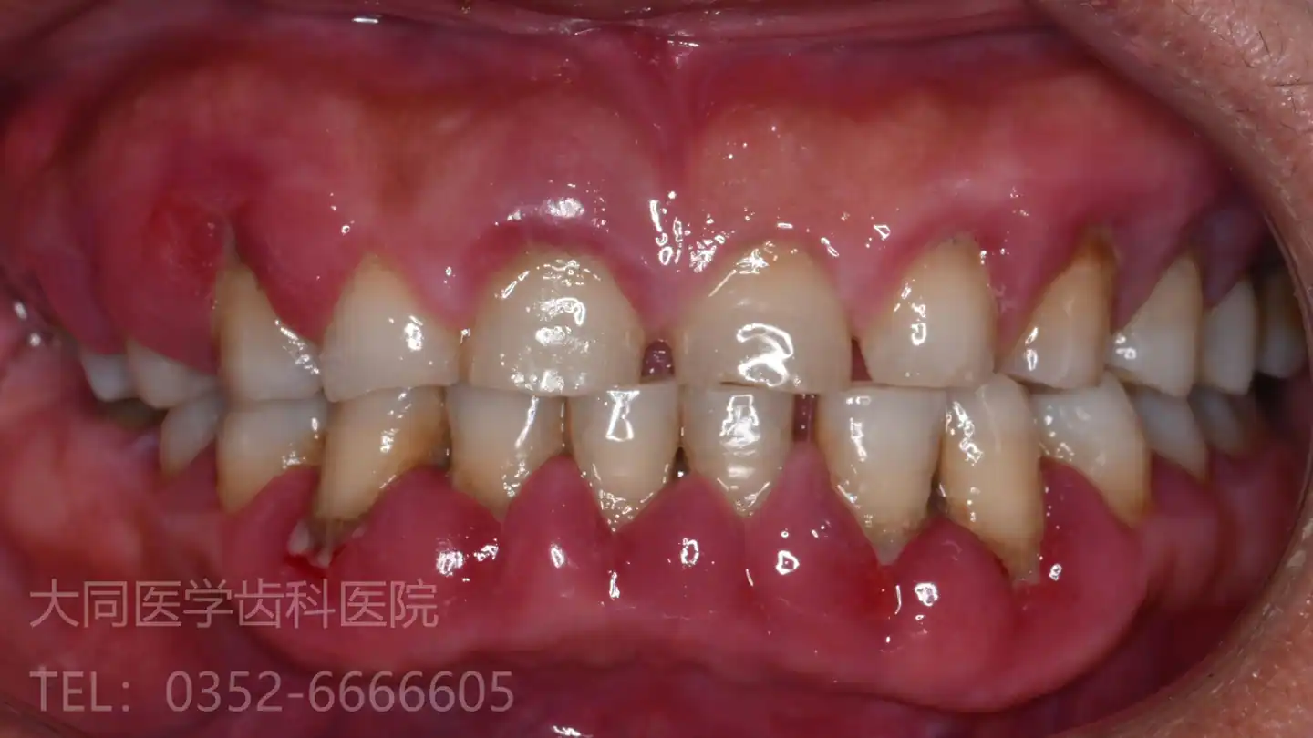牙周治疗:系统化维护方向口内局部影像